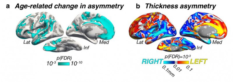 Asymmetric thinning of the cerebral cortex across the adult lifespan is accelerated in Alzheimer’s Disease